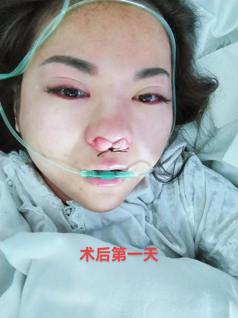 鼻炎手术