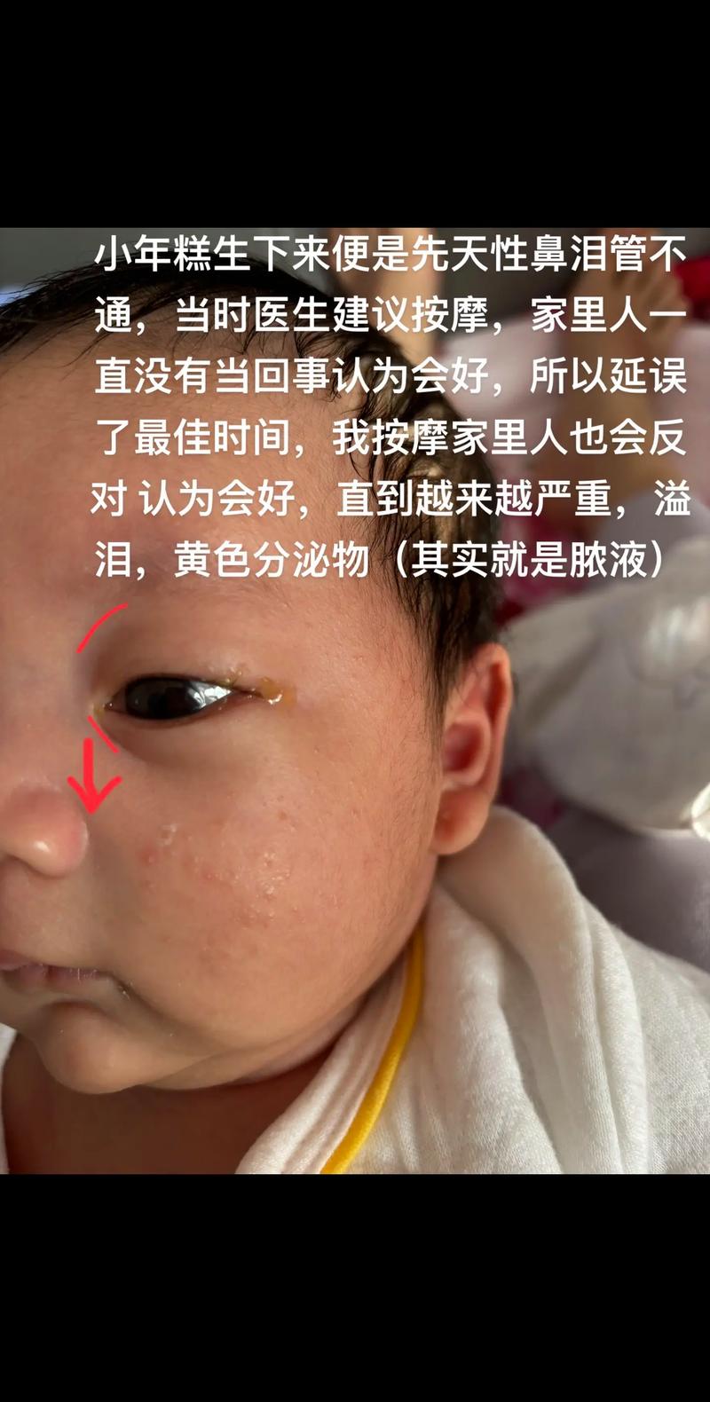 鼻泪管堵塞