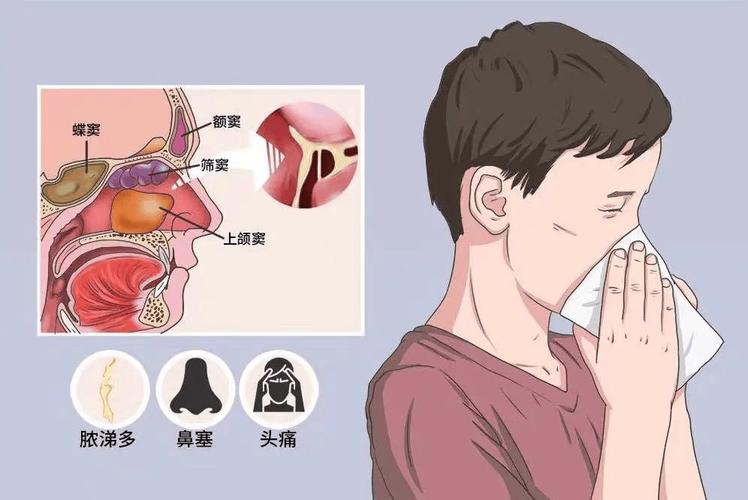鼻痛