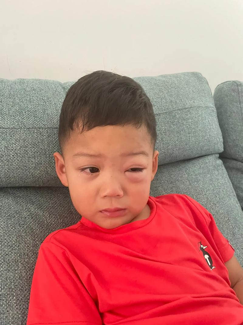 过敏性鼻炎宝宝