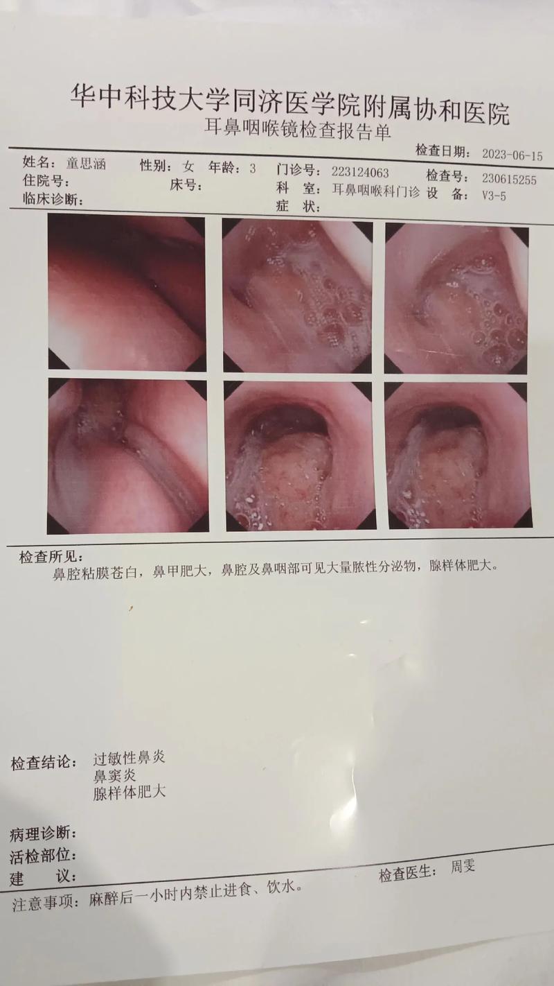 过敏性鼻炎