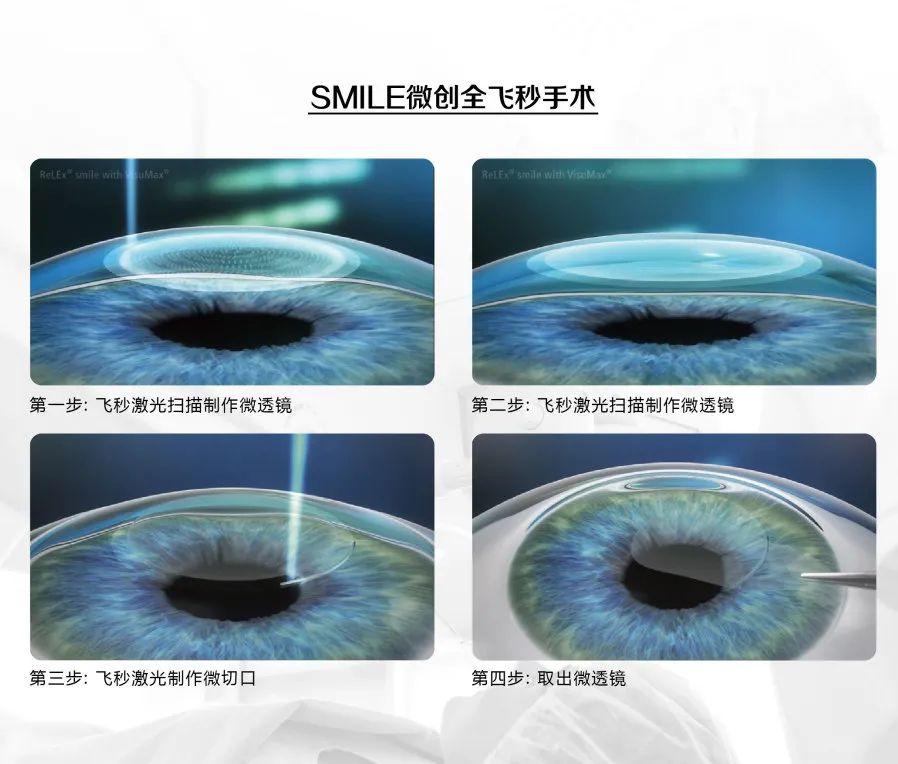 飞秒激光手术