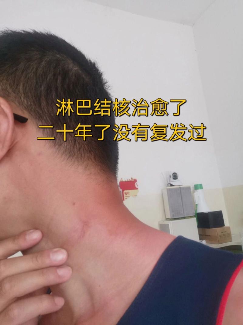 淋巴结肿大