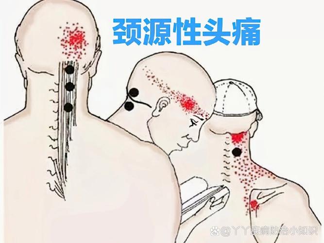 颈源性问题