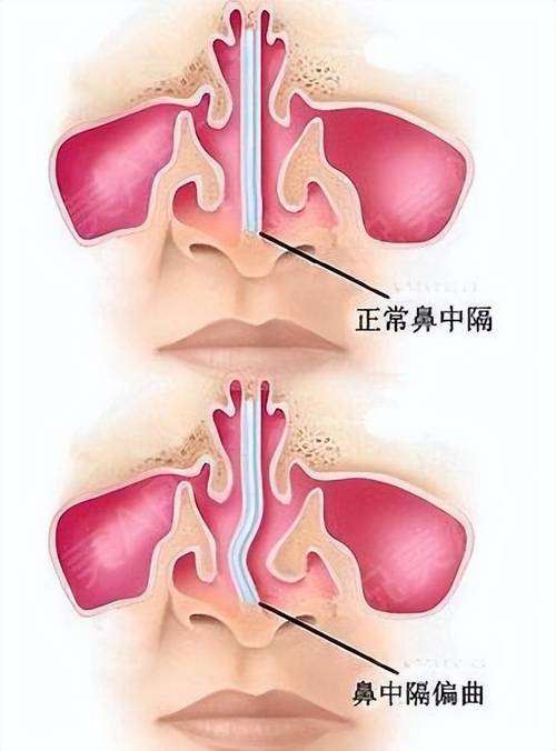 鼻中隔偏曲