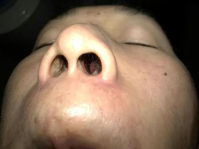 鼻孔发酸