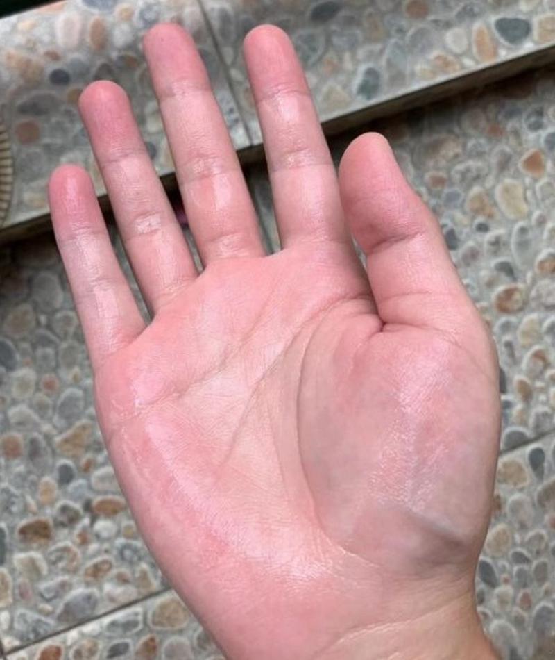 手汗症