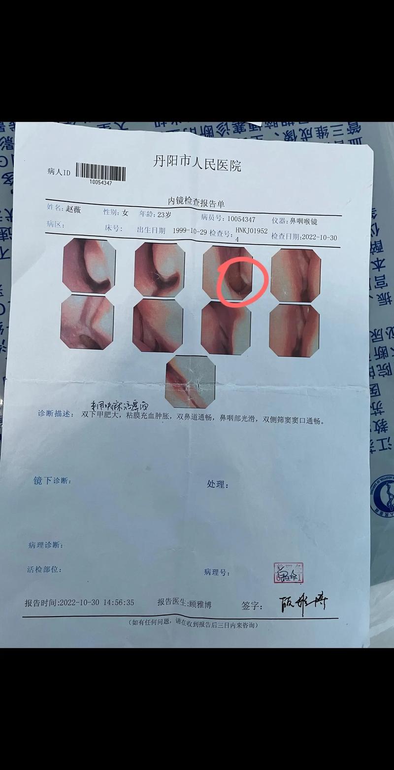缓慢萎缩性鼻炎