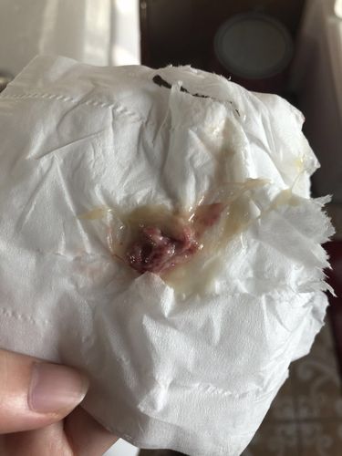 鼻涕流出