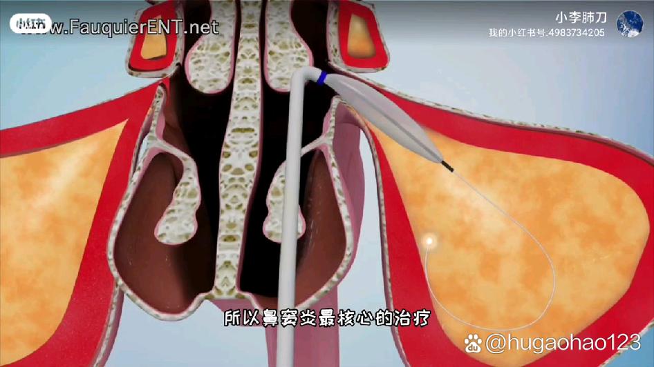 鼻炎治疗过程