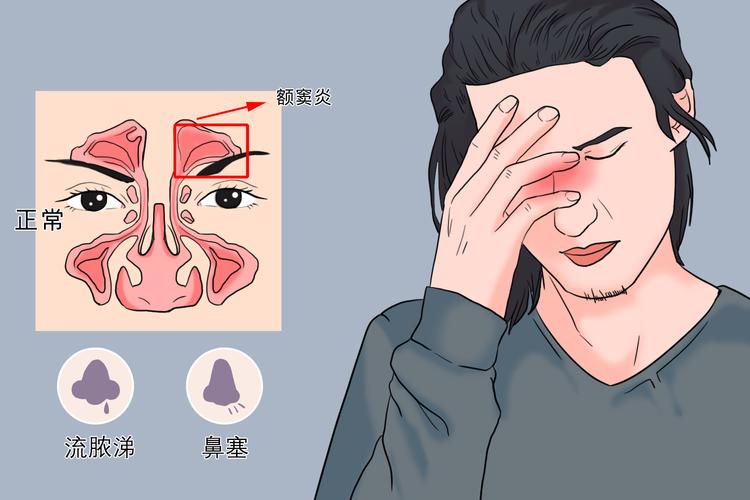额窦炎