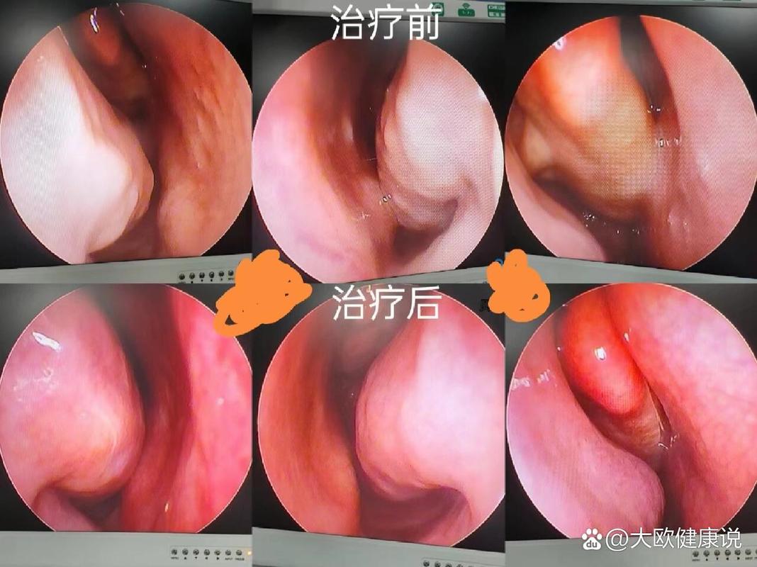 鼻腔检查