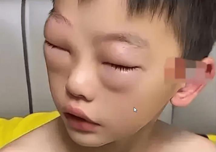 双眼肿胀