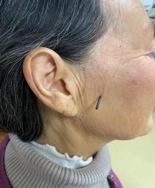 鼻孔针刺感