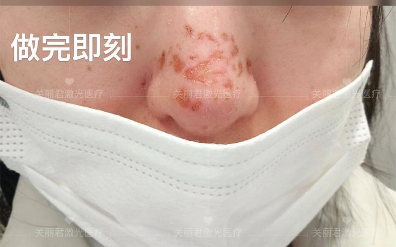 激光治疗鼻炎