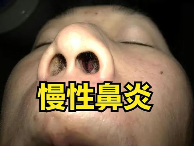 鼻炎严重程度