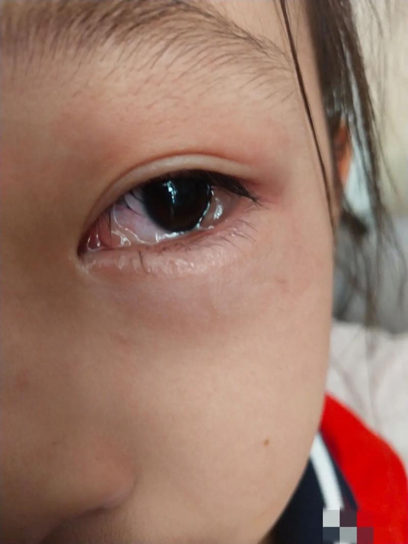 眼痒