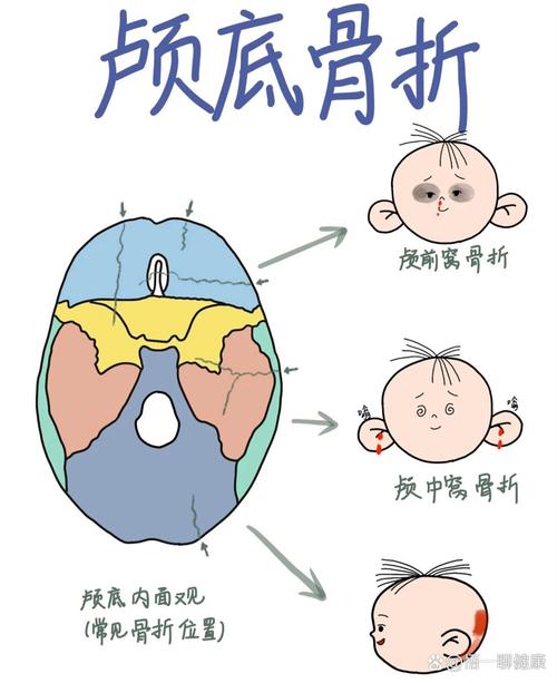 颅底骨折