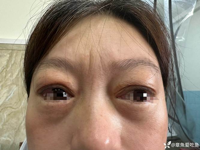 眼部肿胀