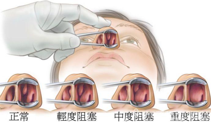 缩窄性鼻炎