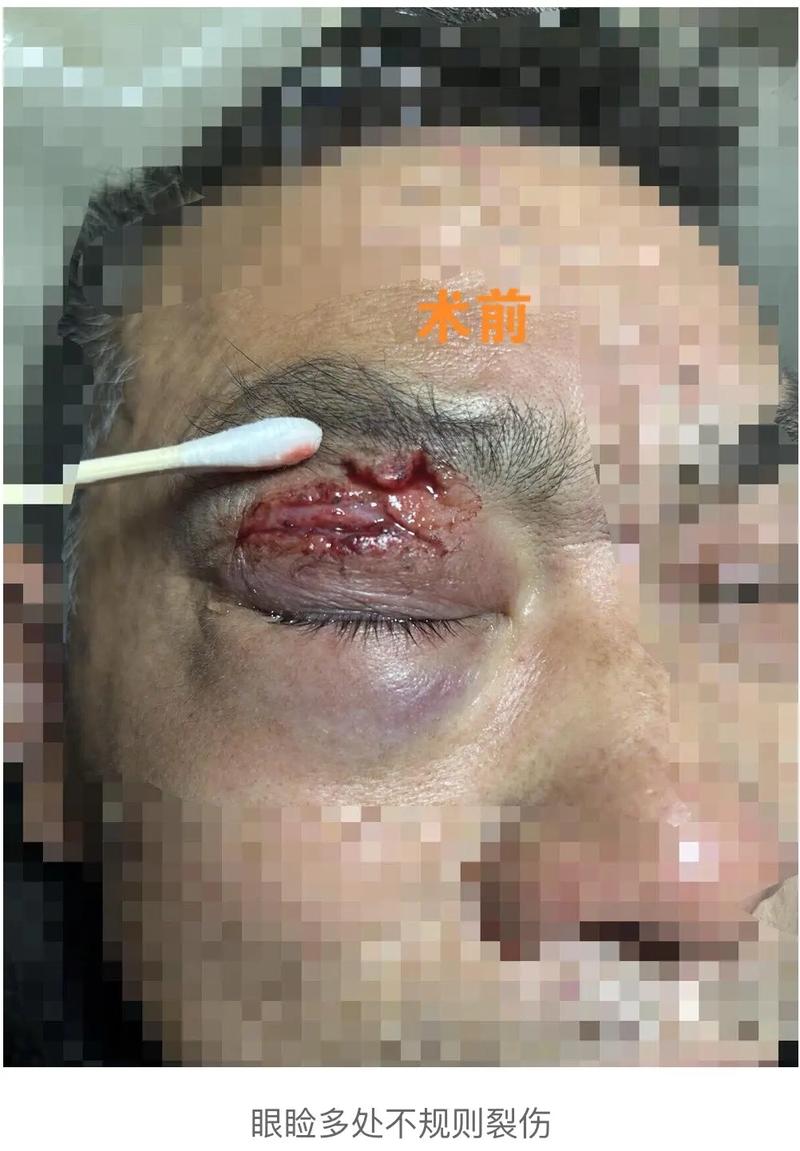 失明