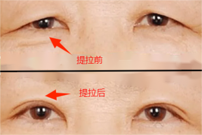 手术效果
