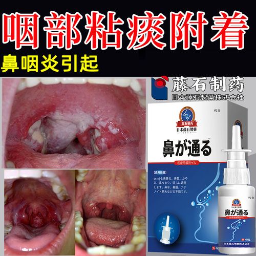 鼻炎痰多