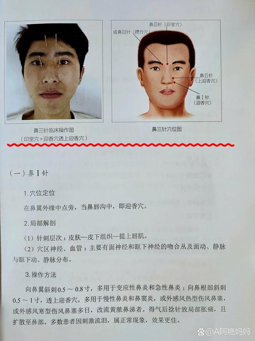 针灸鼻炎疗法