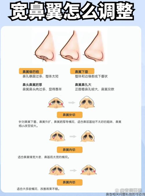 鼻翼增大