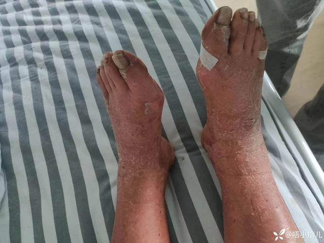 糖尿病患者