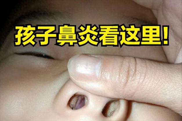  小儿鼻炎