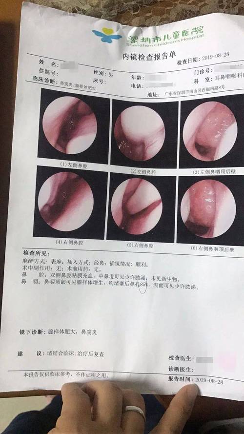  普通鼻炎