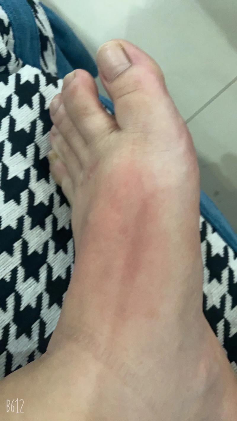 饮食过敏