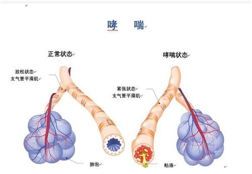 呼吸道高反应性