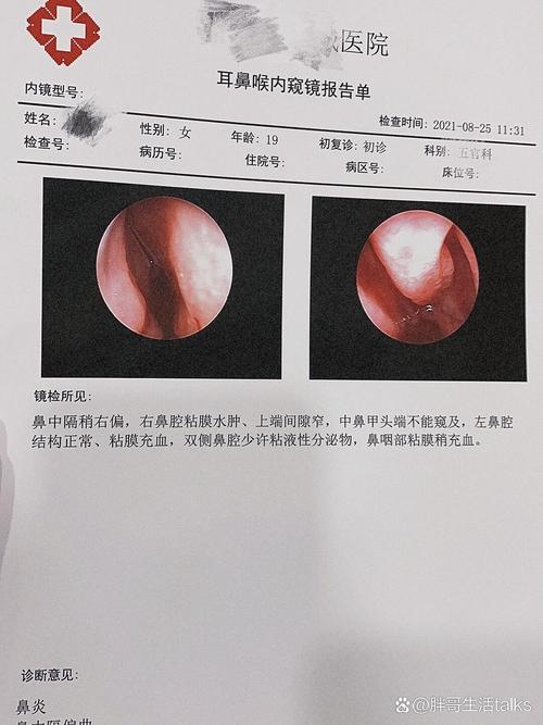 <不严重鼻炎>
