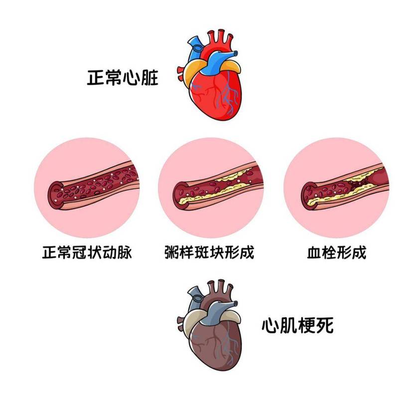 冠心病，鼻炎，过敏性鼻炎，动脉粥样硬化
