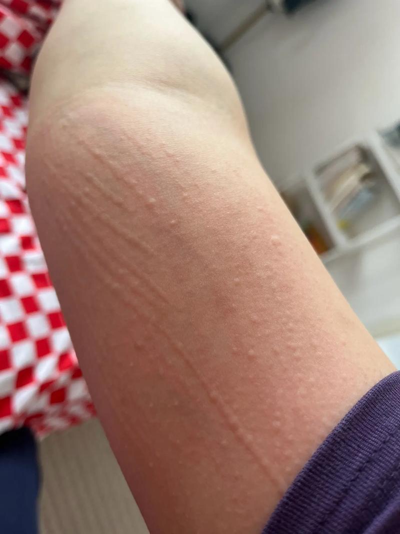 痒症状