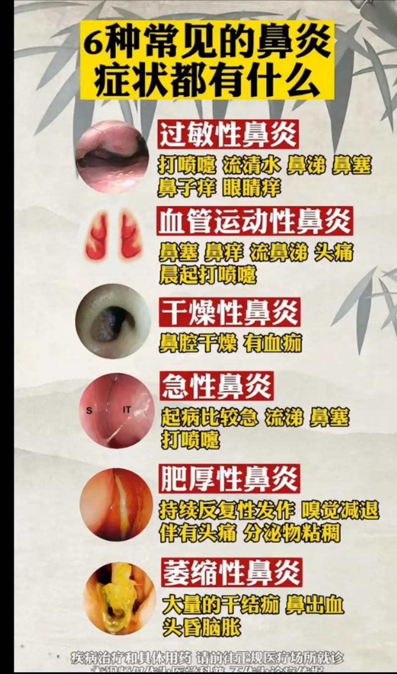 江西鼻炎治疗