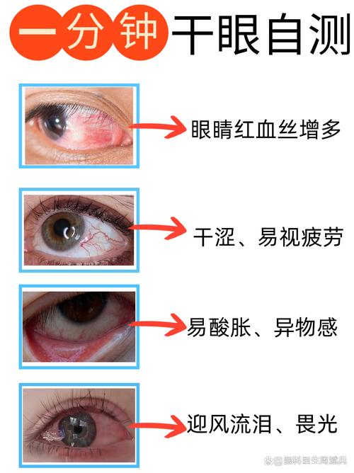 眼干症
