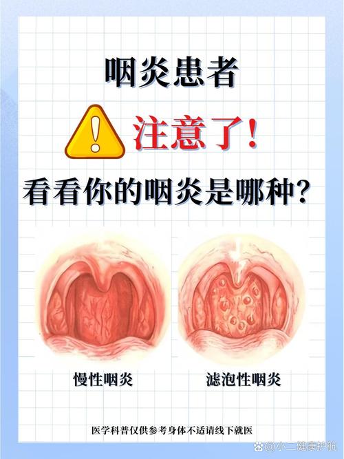 过敏性咽炎