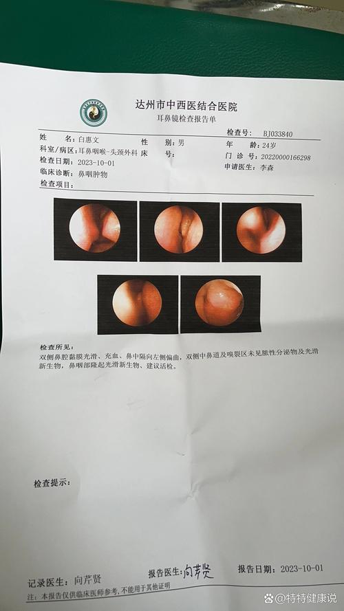 鼻囊肿