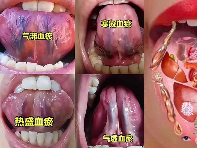 瘀血内阻