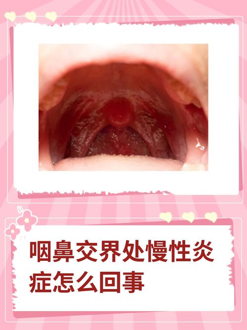  鼻咽部炎症