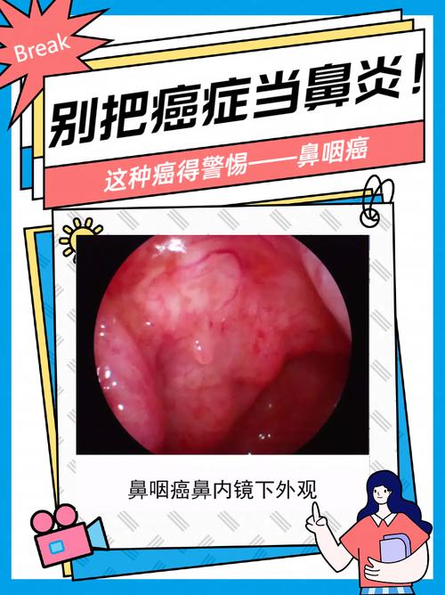 鼻炎晚期是否还有治疗的希望？