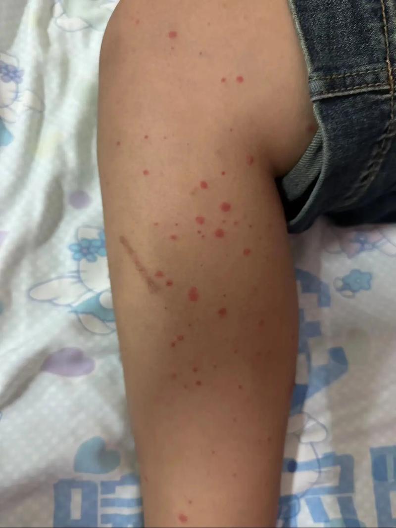 过敏性